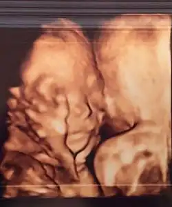 twin ultrasound 21 weeks