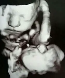 twin ultrasound 28 weeks