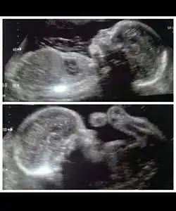 Images ultrasound twin pregnancy 34 Weeks