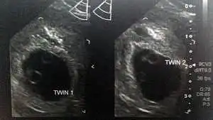 twins ultrasound 6 weeks