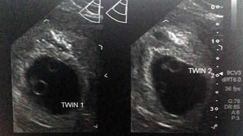 ultrasound pregnancy