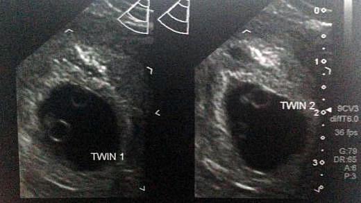 4 Weeks Pregnant With Twins Twin Pregnancy Symptoms About Twins