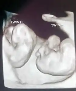 twin ultrasound 9 weeks