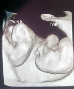 identical twins ultrasound 10 weeks