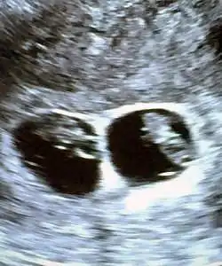 mo-di twin ultrasound 9 weeks