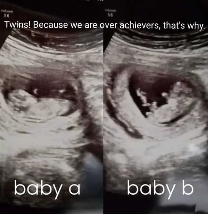 twin pregnancy announcement ultrasound scan picture