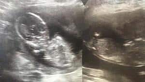 Dichorionic twin ultrasound picture at 13+5 weeks