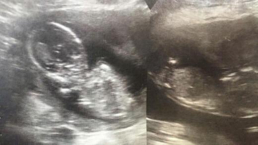 14 Weeks Pregnant With Twins: Belly, Ultrasound, Symptoms & Development ...